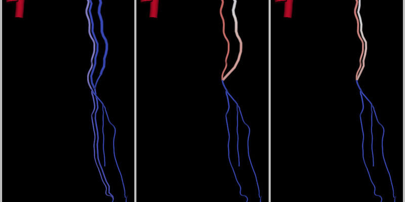Voorspellingen van de gevolgen van de aanleg van een dialyse-fistel op drie verschillende plaatsen: onderarm (RC-AVF), bovenarm (BB-AVF) en nogmaals in de bovenarm (BC-AVF). Rood geeft veel bloedstroming aan, blauw weinig. Het model voorspelt dat er heel veel bloedstroming optreedt als de fistel in de bovenarm wordt gemaakt, terwijl er in de onderarmsonfiguratie voldoende flow zal zijn. Dus de onderarmfistel heeft de voorkeur.