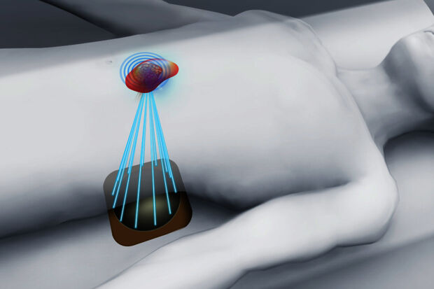 Inducing accurately controlled ‘fever’ in tumors to fight cancer