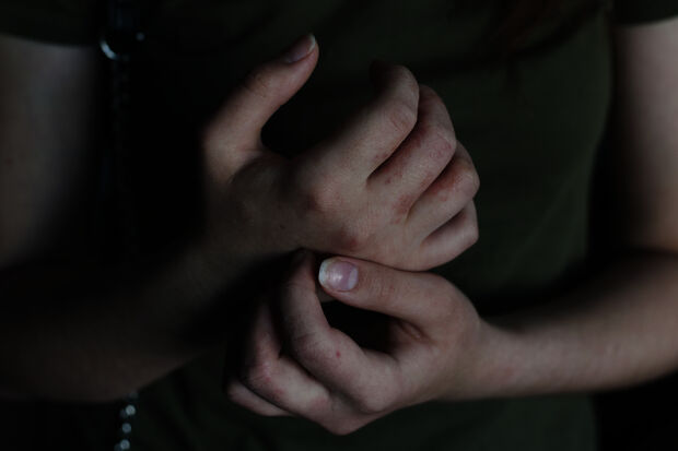 What it is like to have scabies
