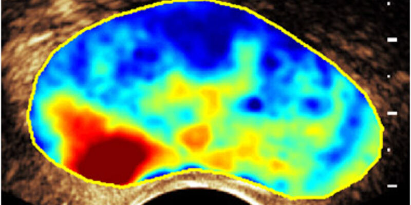 Een beeld van een prostaat, gegenereerd met de nieuwe technologie. De rode vlek laat zien waar tumorweefsel zit.