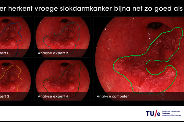 TU/e software helps recognizing early esophageal cancer 