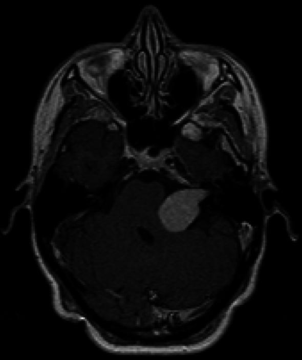MRI-beeld met iets rechts van het midden een grote brughoektumor. Afbeelding | Elisabeth-TweeSteden Ziekenhuis