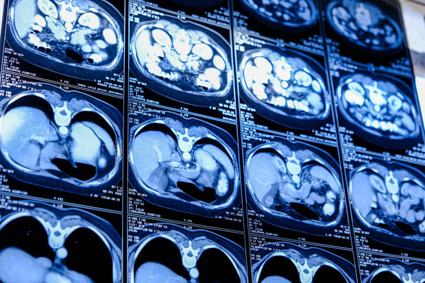 AI can spot patterns in CT scans thanks to supercomputer